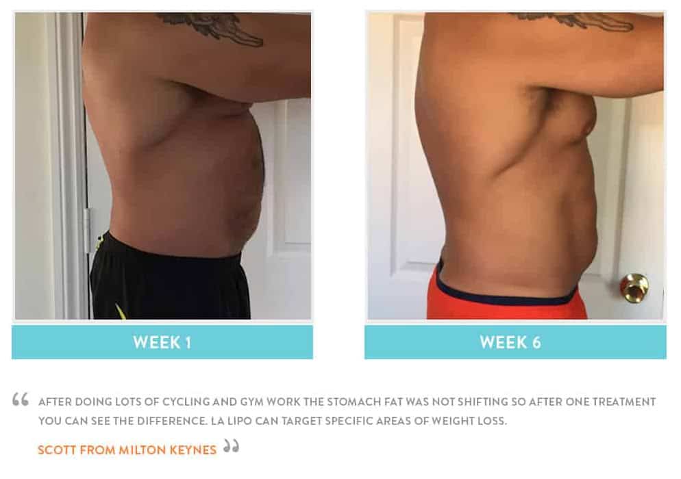 Before & After Stomach Fat Lincoln