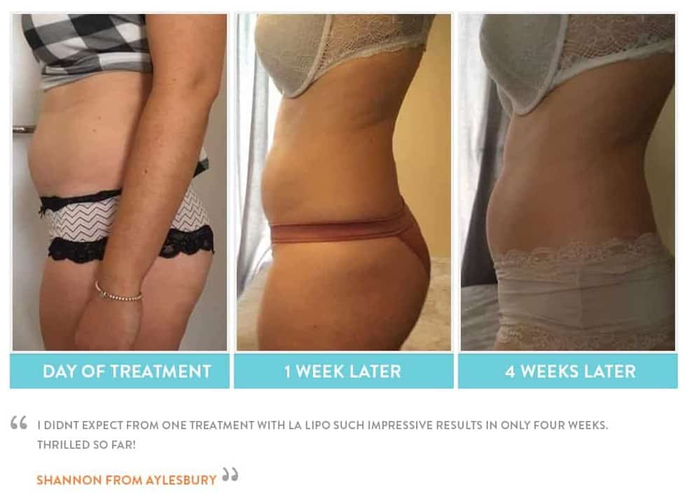 before, Cryolipolysis Lincoln
