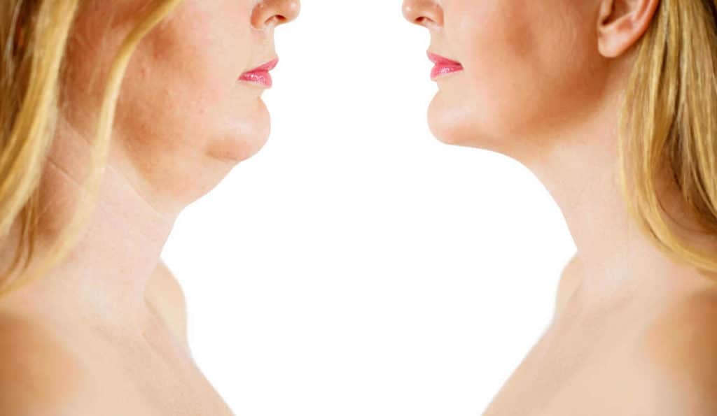 Double Chin treatment Lincoln before and after results