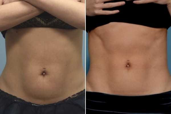 body sculpting FAQs Lincoln