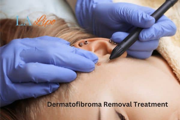 Dermatofibroma Removal Treatment Lincoln