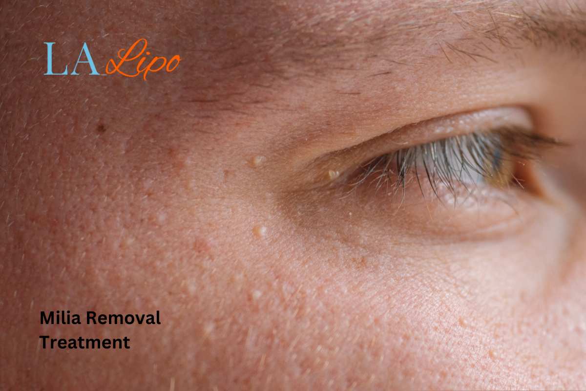Cryopen Milia Removal: Is It the Easiest and Safest Option Lincoln?