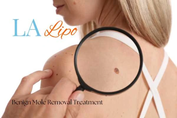 Woman having her inspection of blemish before mole removal Lincoln