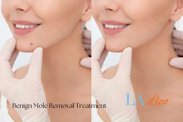 Before and after mole removal Lincoln treatment