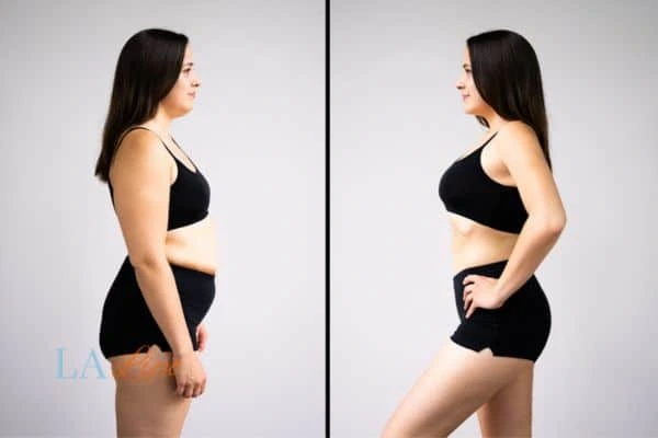 LA-EMS Body Sculpting Lincoln results before and after of womans results on body toning.