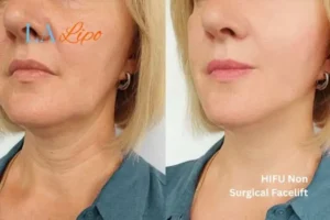 hi-fu for wrinkles Lincoln before and after results