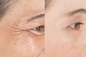 Before and after results of woman - HI-fu wrinkles reduction treatment Lincoln