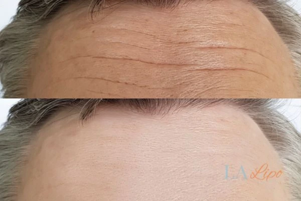 results of HIFU Lincoln on mans forehead to help reduce lines and wrinkles