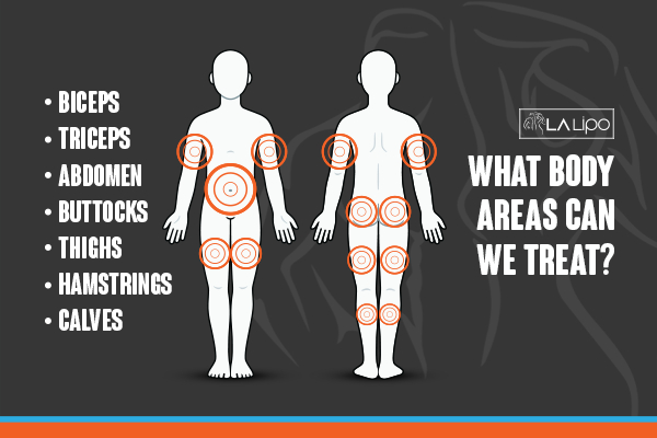 Graphic to show areas you can have LA-EMS Body Sculpting Lincoln treatment.
