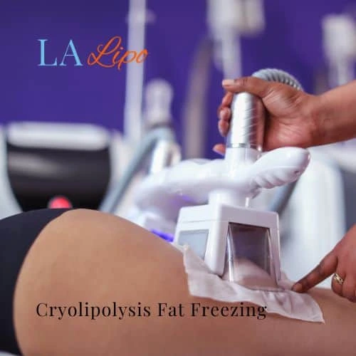 fat freezing - Cryolipolysis Lincoln