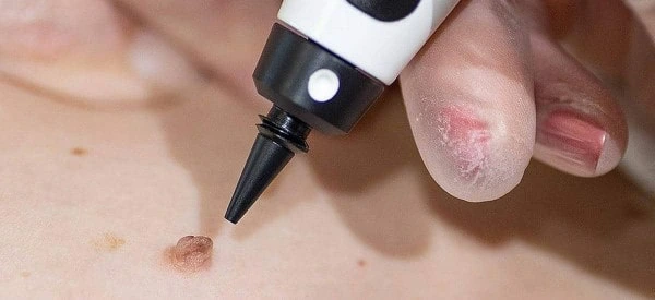 skin tag removal using cryopen Lincoln