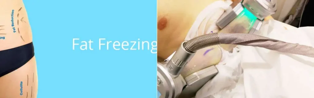 multi areas of a persons body having coolsculpting Lincoln treatment