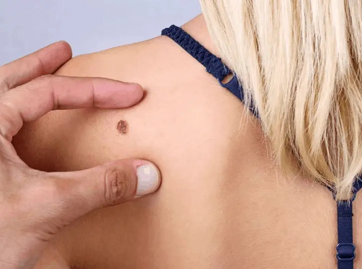 woman having mole removal Lincoln consultation before treatment.