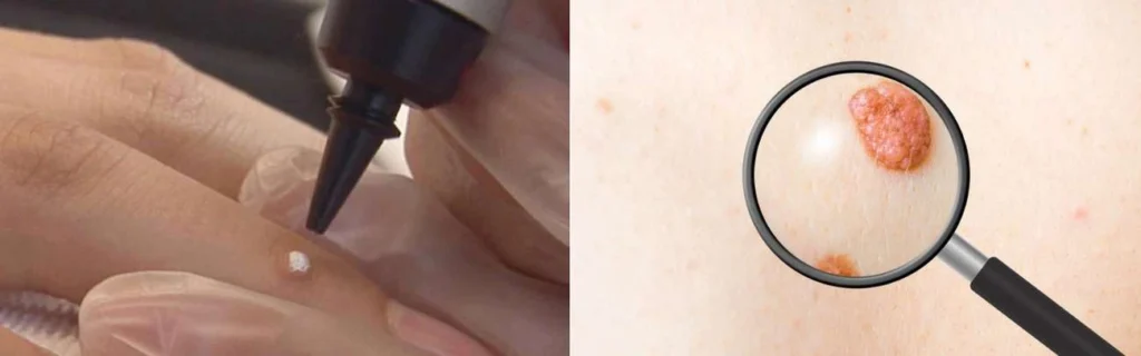 Person getting moles removed with cryopen Lincoln