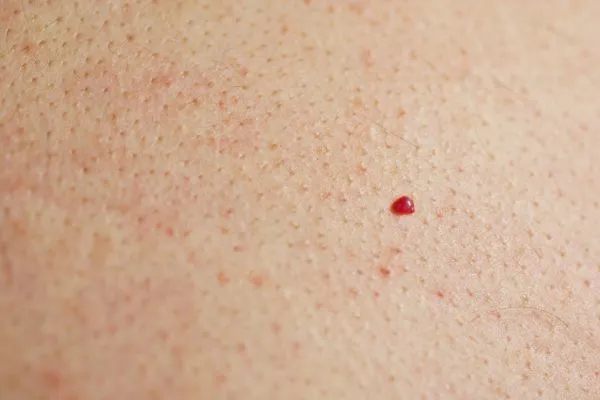 close up of a cherry angioma Lincoln
