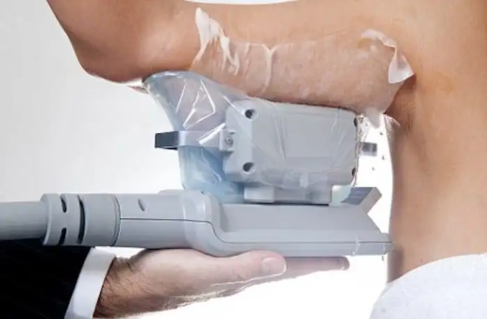 Picture of fat freezing Lincoln on the upper arms.