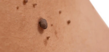image of a skin tag Lincoln