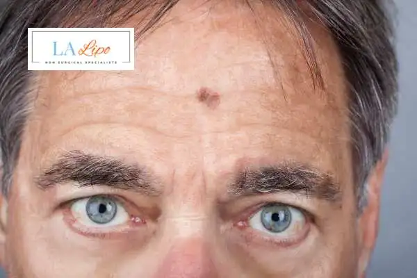 Solar Lentigo Removal Lincoln image of man with mark on his forehead