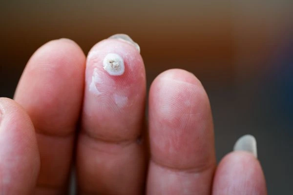 wart on person finger - cryotherapy to treat from LA LIPO Lincoln