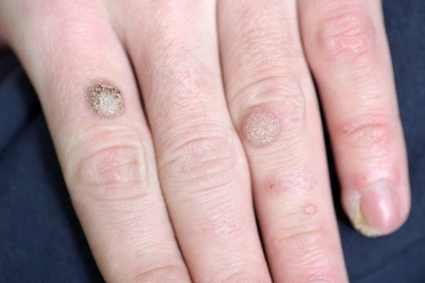 photo of warts on person hand - see wart removal Lincoln from LA LIPO