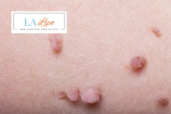 Does cryopen skin tag removal Lincoln hurt? Find out now call our team today!