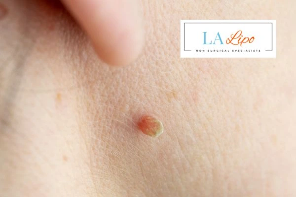 Book skin tag removal Lincoln today speak to our team now!