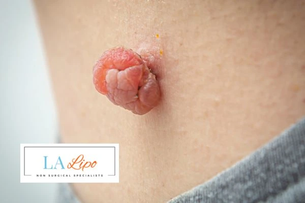 Interested in skin tag removal Lincoln? Concerned about the pain? Find out more today!