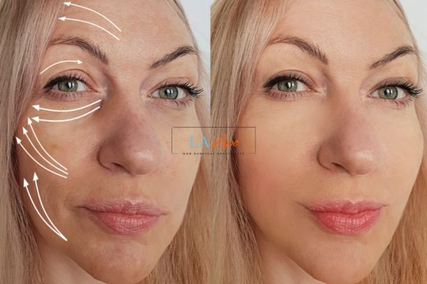 Morpheus 8 results Lincoln face lift.