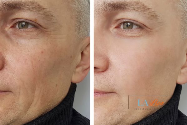 See the amazing results of Morpheus8 Treatment Lincoln!