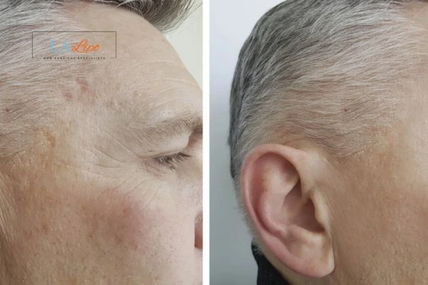 Mens Before & After Morpheus 8 Results Lincoln