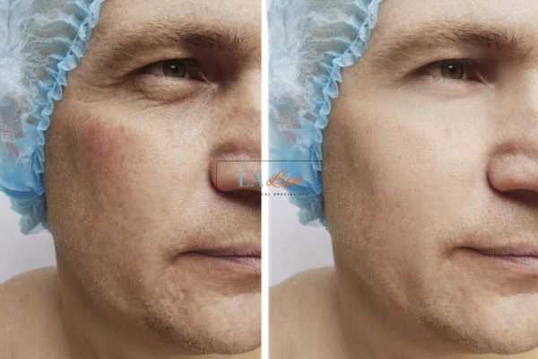 Before and after Morpheus 8 Results Lincoln
