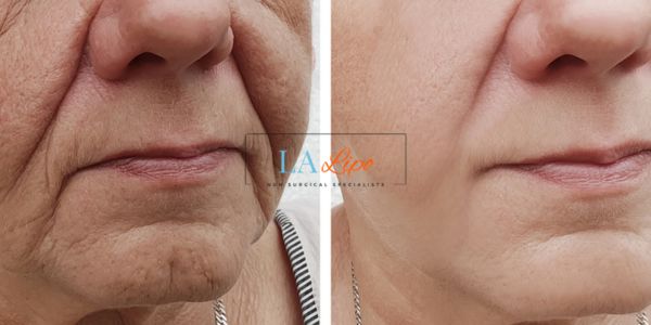 Older lady deeper wrinkle reduction - LA LIPO Morpheus 8 Results Lincoln