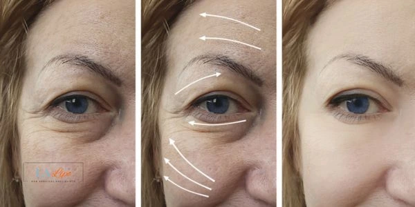 Amazing eye lift Morpheus 8 results Lincoln