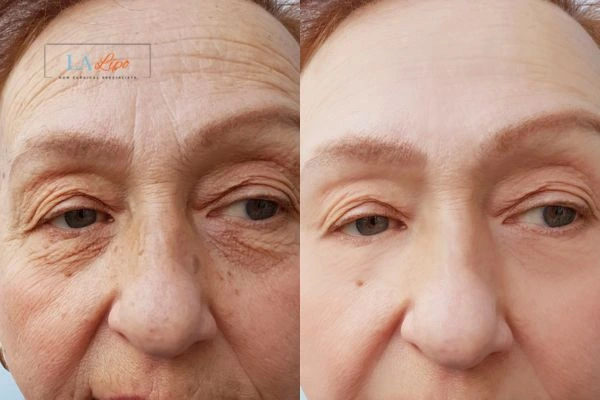 The powerful benefits of Morpheus8 Treatment Lincoln - Call Our team today!