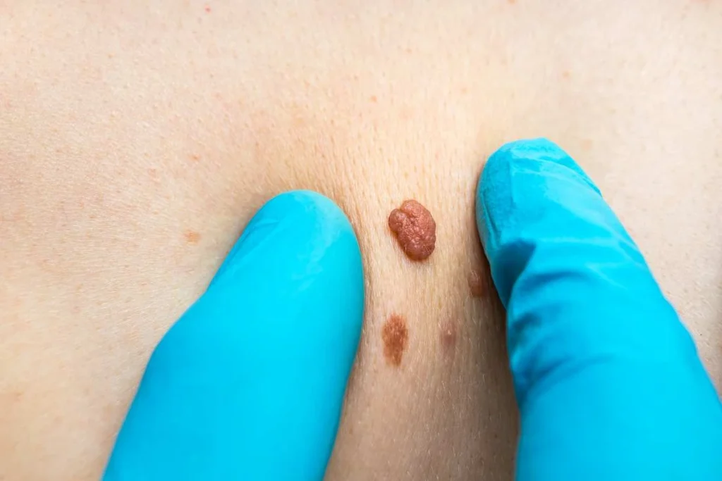 LA LIPO Cryopen Lesion Removal Prices Lincoln