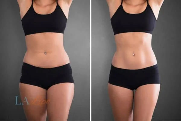 before and after results of non-surgical treatment to help a woman's body image and mental health Lincoln