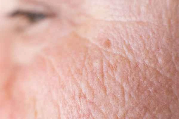 close up picture of a woman's face showing an age spot Lincoln
