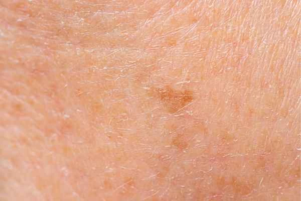 close up picture of age spots Lincoln