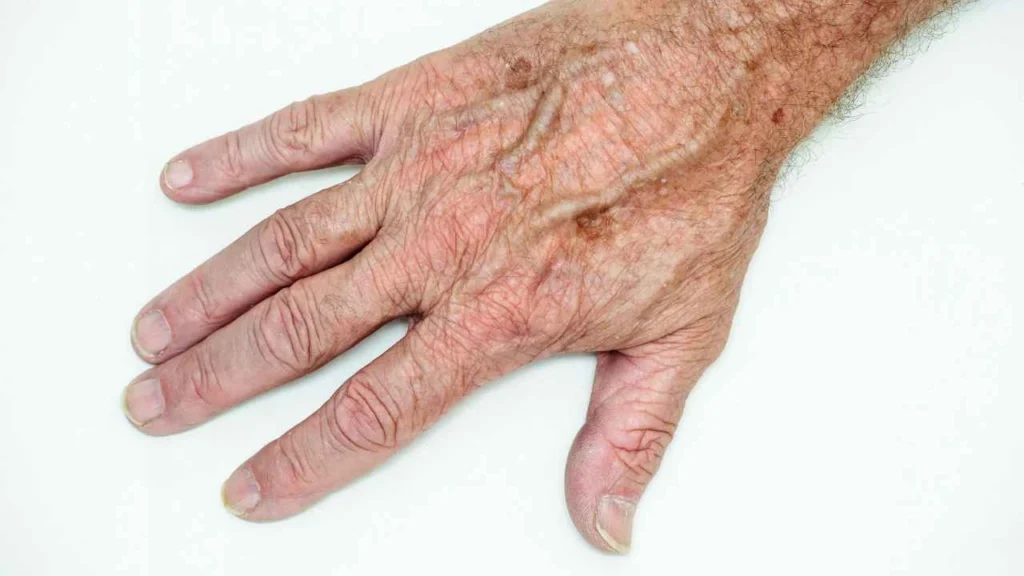 Male hand showing age spot Lincoln