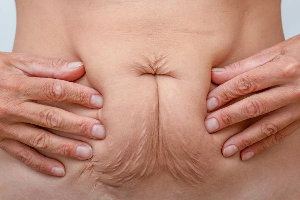 Image of a woman's stomach with loose skin - example of skin tightening Lincoln options