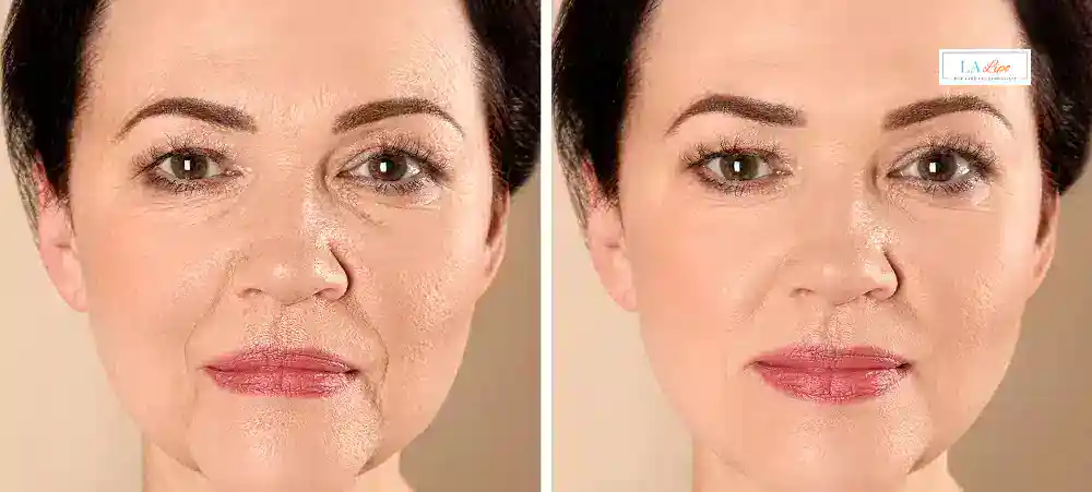 How Long Does It Take to See Results and How Long Do They Last Lincoln?