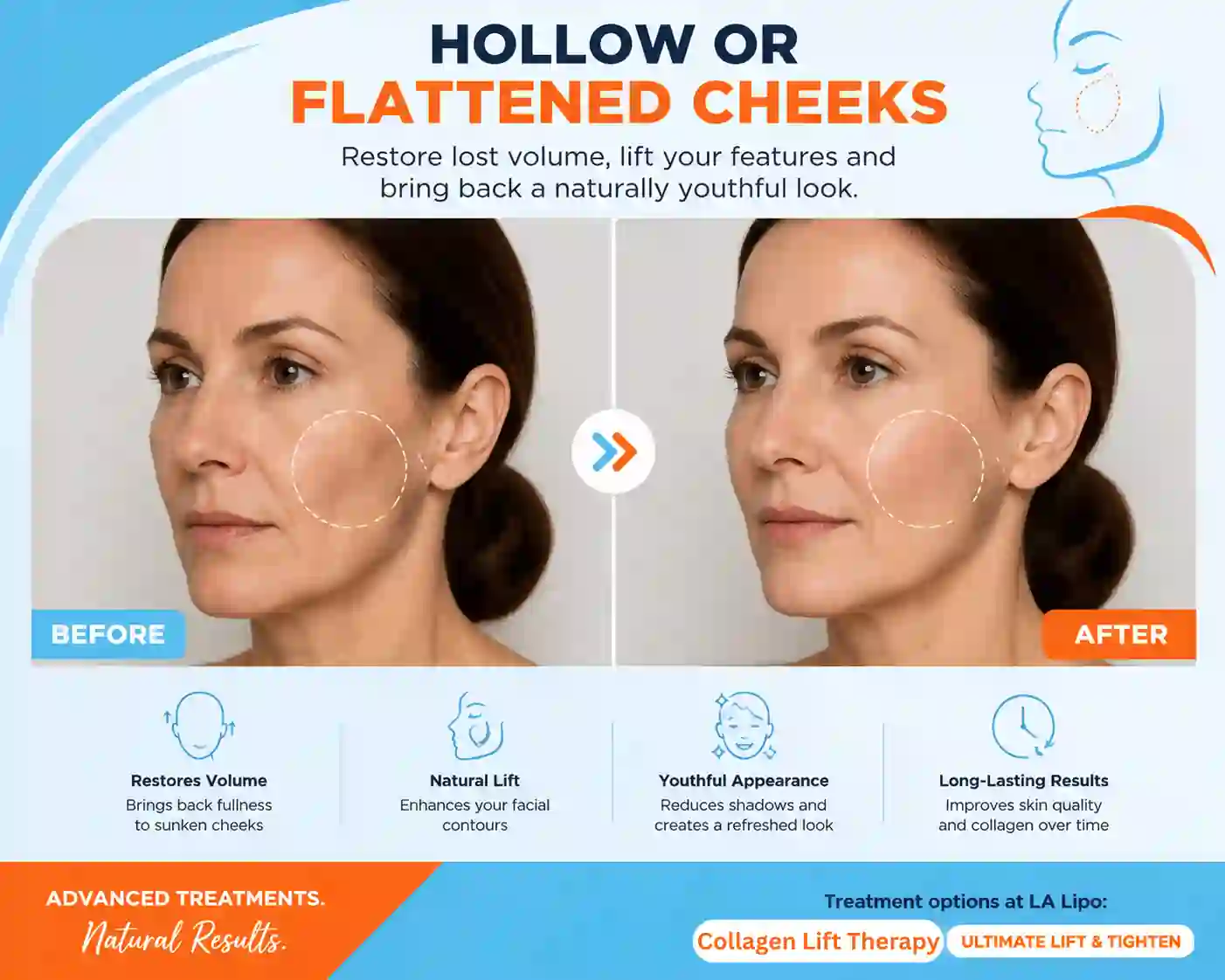 Sign #4: Hollow or Flattened Cheeks Lincoln